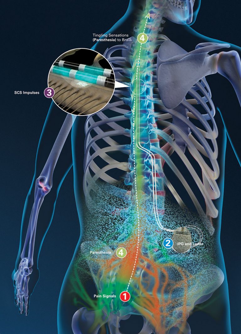 spinal cord stimulation leads dorsal column