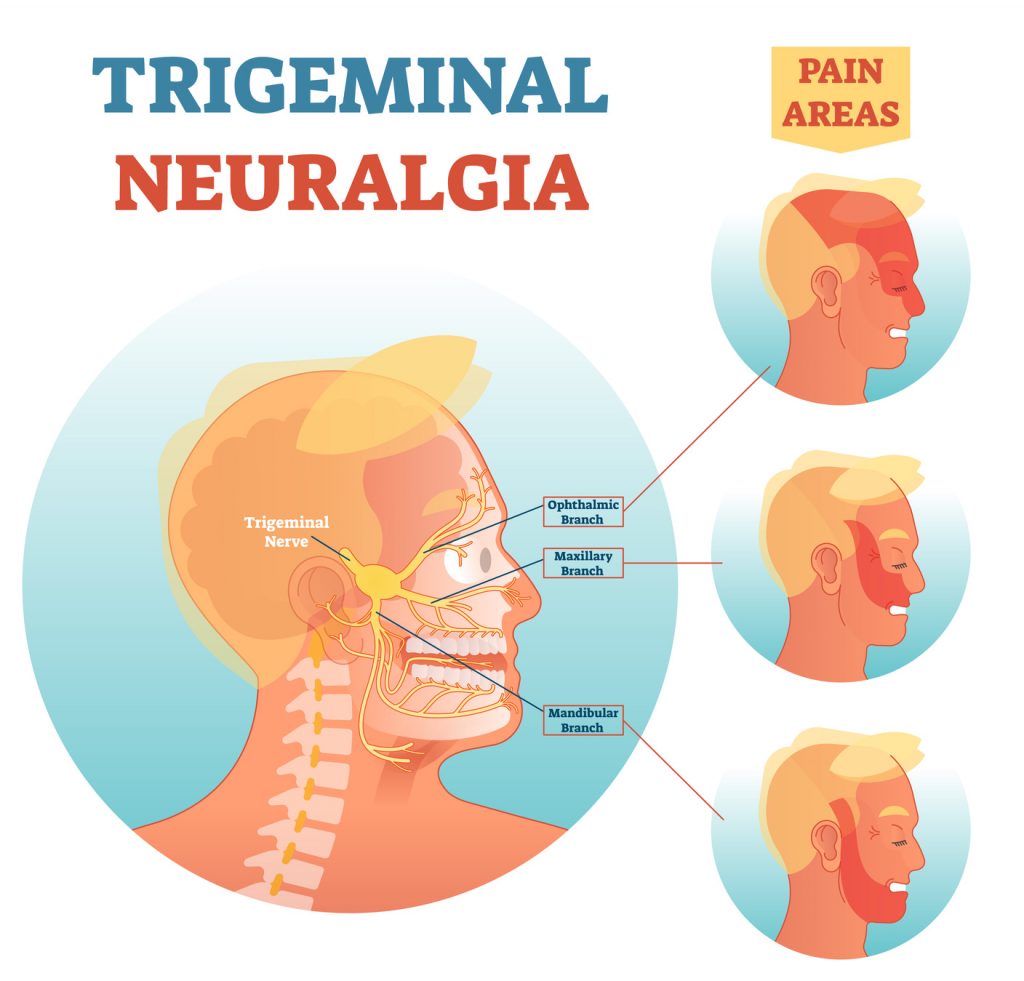 Trigeminal Neuralgia Pain Medicine Fellowsips